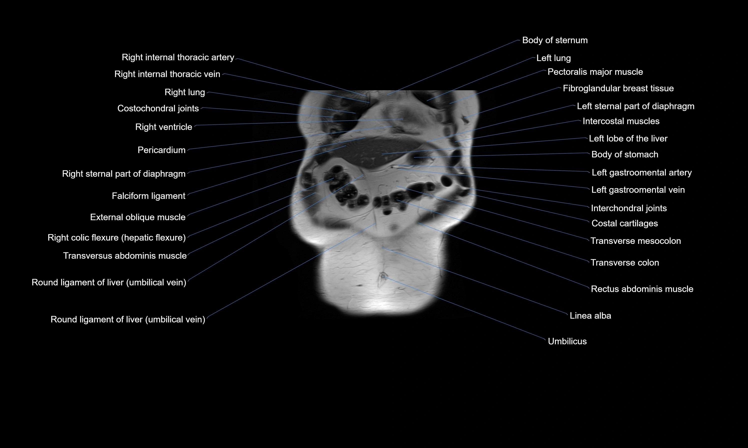 MRI Abdomen axial cross sectional anatomy radiology  image-img-00001-00010.webp